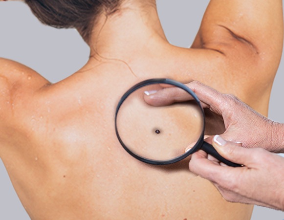 junho-preto-melanoma