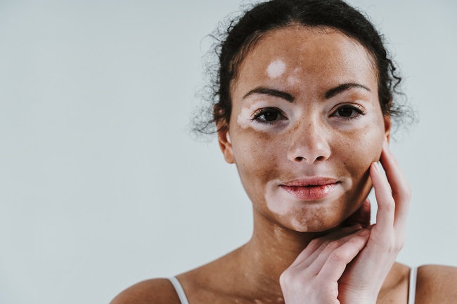vitiligo
