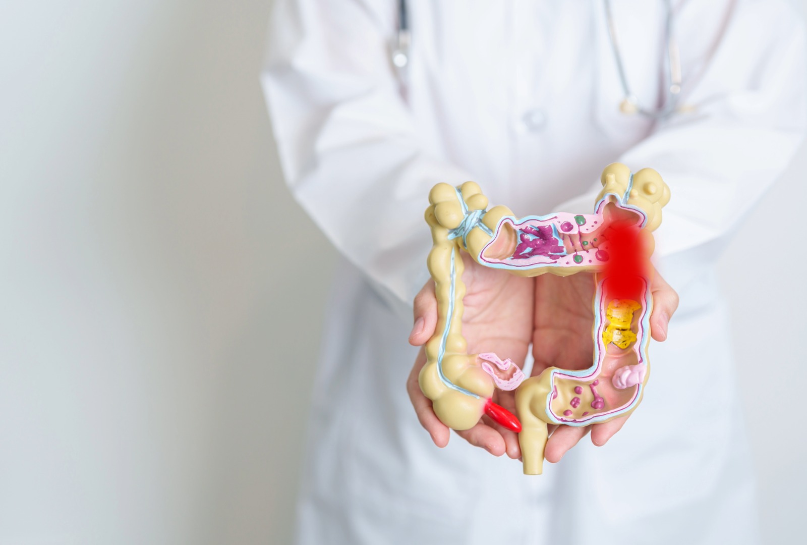 novas-perspectivas-cancer-colorretal