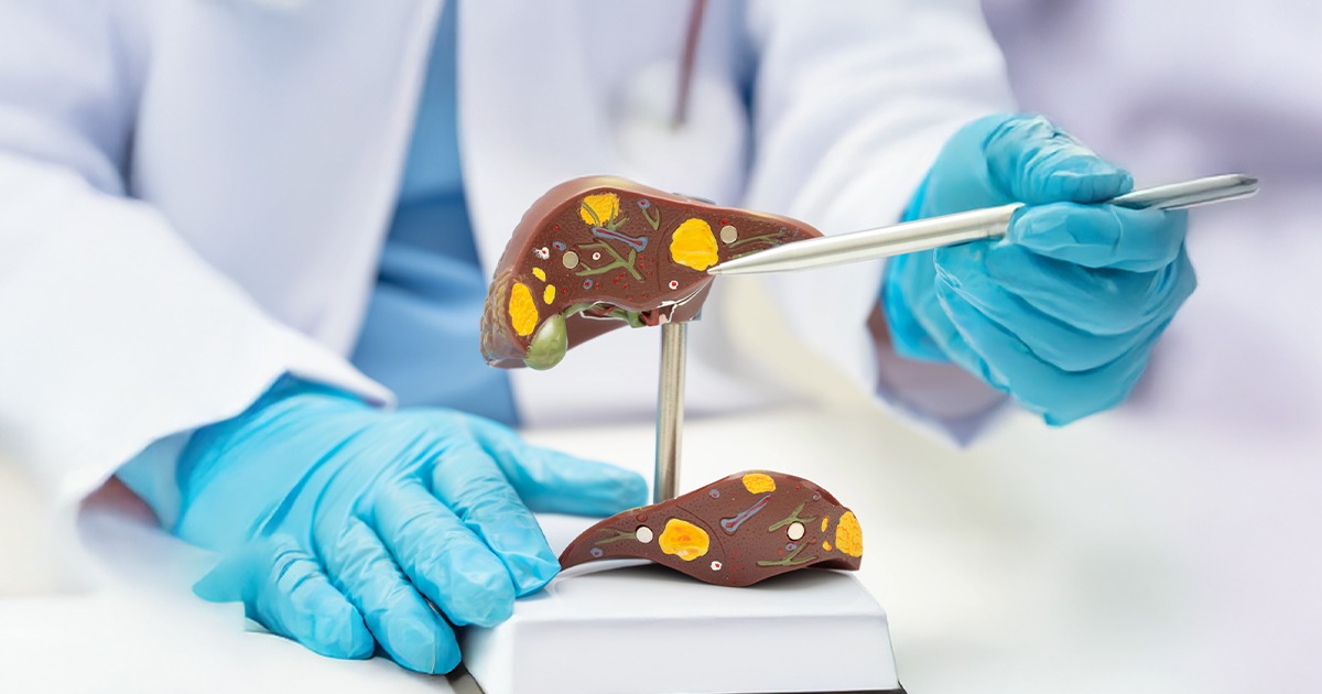 gordura-figado-cancer